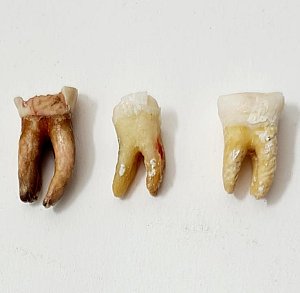 Premolar Human Teeth