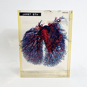 Lung Preserved In Case Showing Blood Vessels & Damage