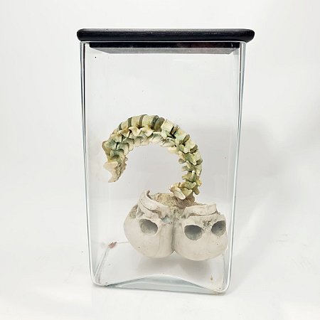 Conjoined Baby Head & Spine In Jar