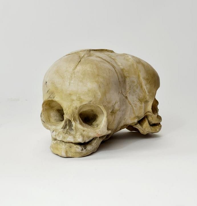 Conjoined Baby Skull Model