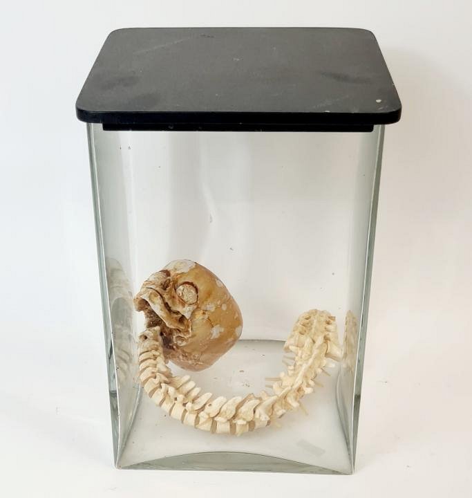 Child Skull &Spine Section In Glass Jar