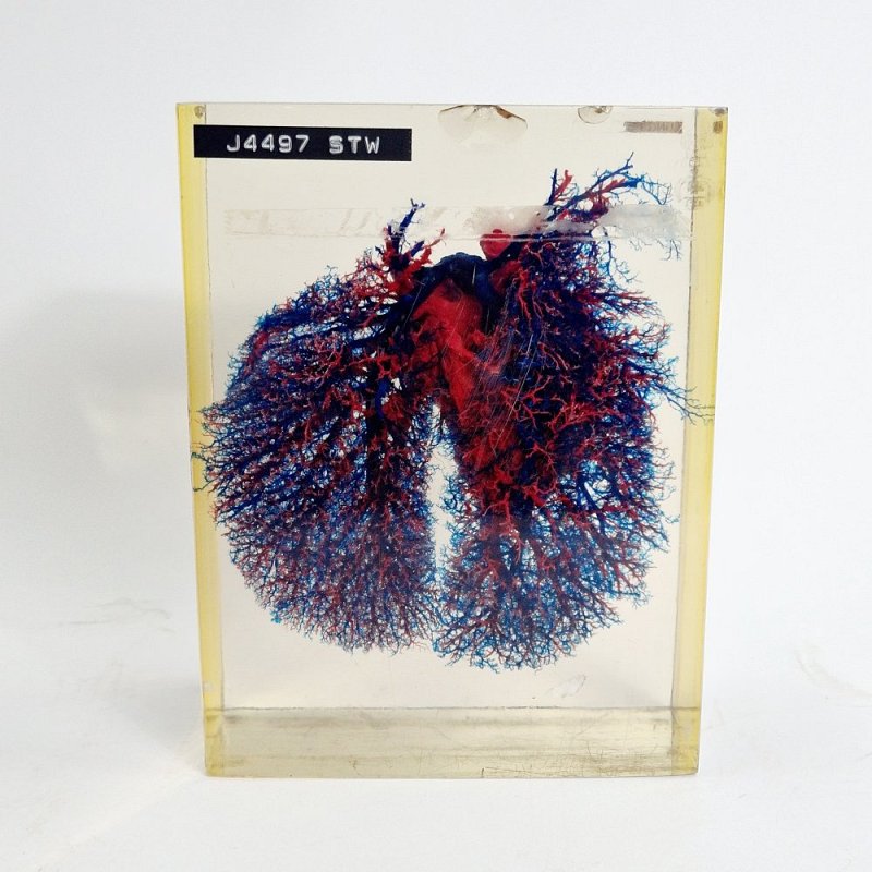 Lung Preserved In Case Showing Blood Vessels & Damage