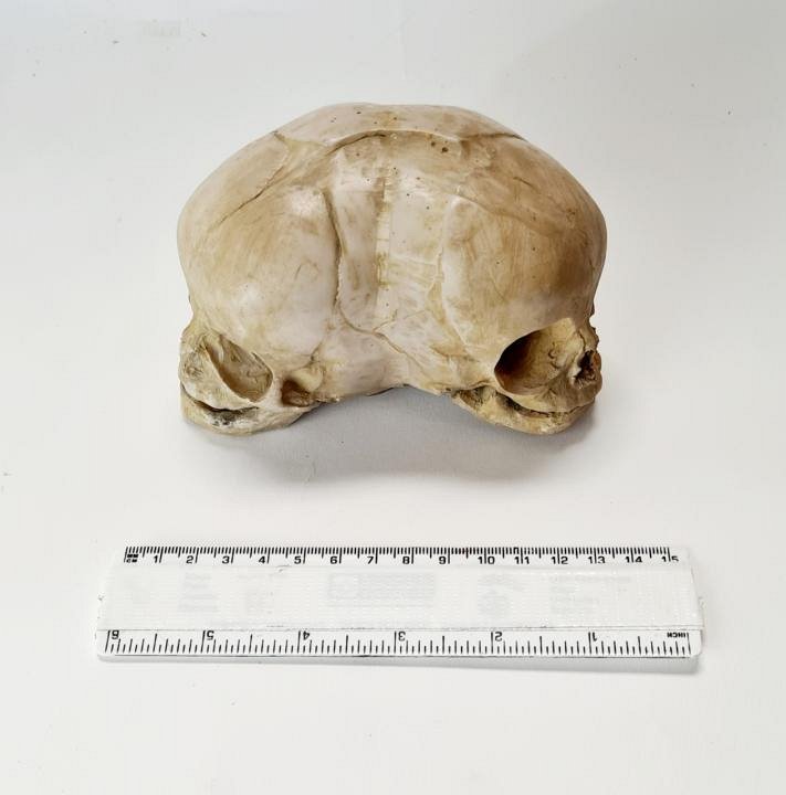 Conjoined Baby Skull Model