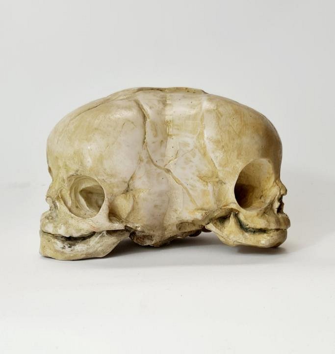 Conjoined Baby Skull Model