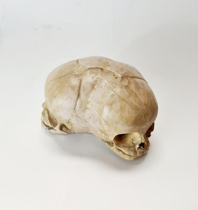 Conjoined Baby Skull Model
